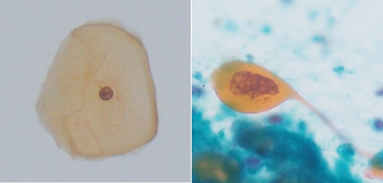 正常細胞(左)とがん細胞(右)