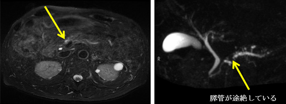 膵臓がん（矢印）のMRI